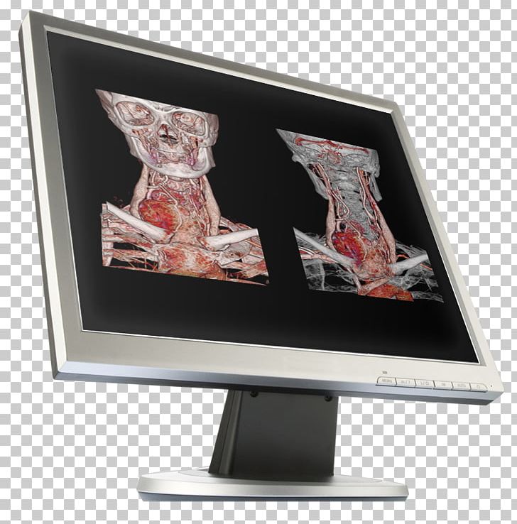 Computer Monitors Workflow Computed Tomography Canon Medical Systems Corporation PNG, Clipart, Canon, Canon Medical Systems Corporation, Computed Tomography, Computer Monitor, Computer Monitors Free PNG Download