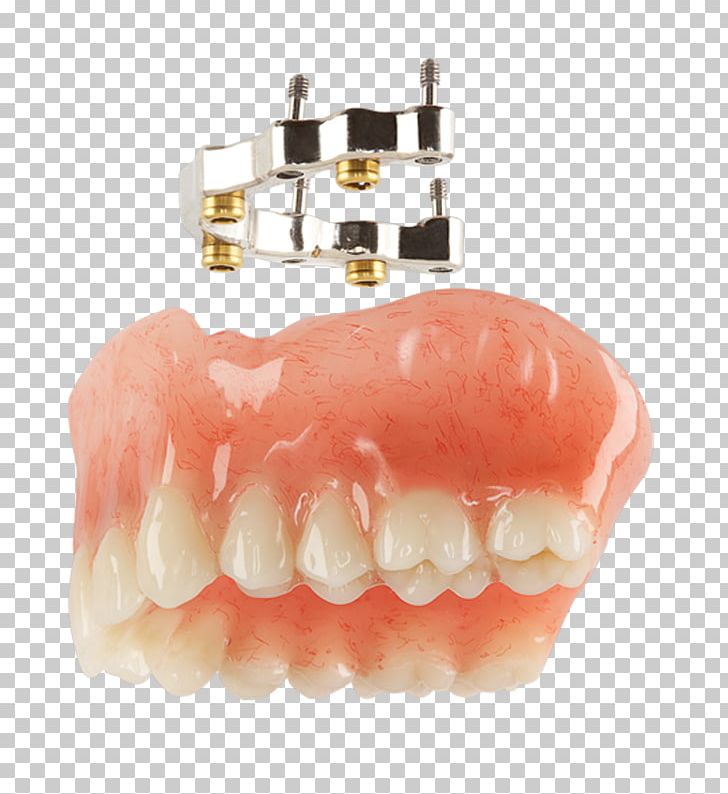 Overdentures Tooth Dental Implant Implant Bars PNG, Clipart, Allon4, Crafter, Den, Dental, Dental Crafters Inc Free PNG Download