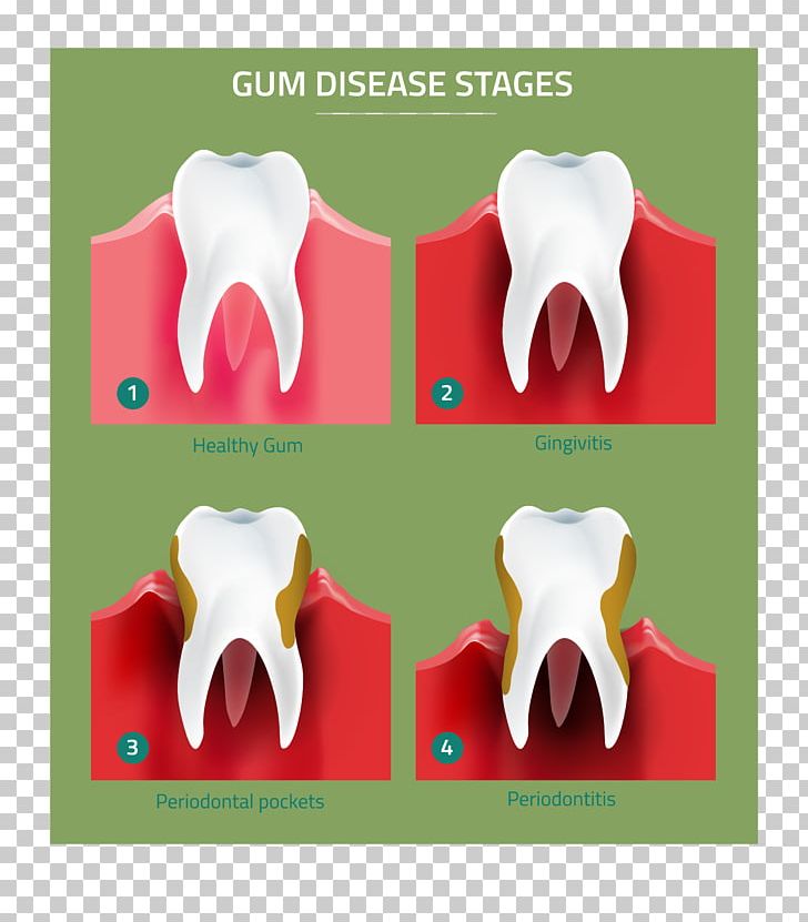 Tooth Gums Periodontal Disease Gingivitis Periodontology PNG, Clipart, Bone, Dentist, Dentistry, Disease, Gingival Recession Free PNG Download