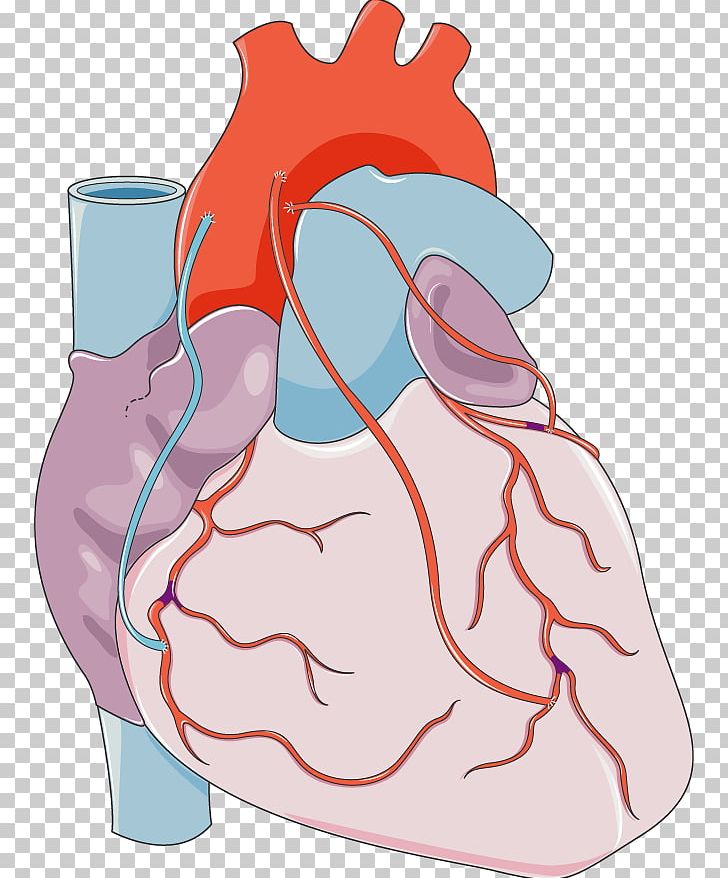 Heart Coronary Artery Bypass Surgery Vascular Bypass Coronary Arteries PNG, Clipart, Acute Myocardial Infarction, Area, Art, Artery, Bypass Free PNG Download