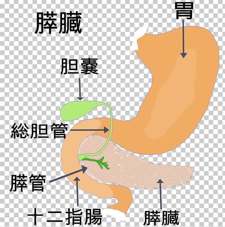 Gallbladder Disease Gallstone Pancreas Pancreatitis PNG, Clipart, Angle, Area, Arm, Bile, Cholecystectomy Free PNG Download