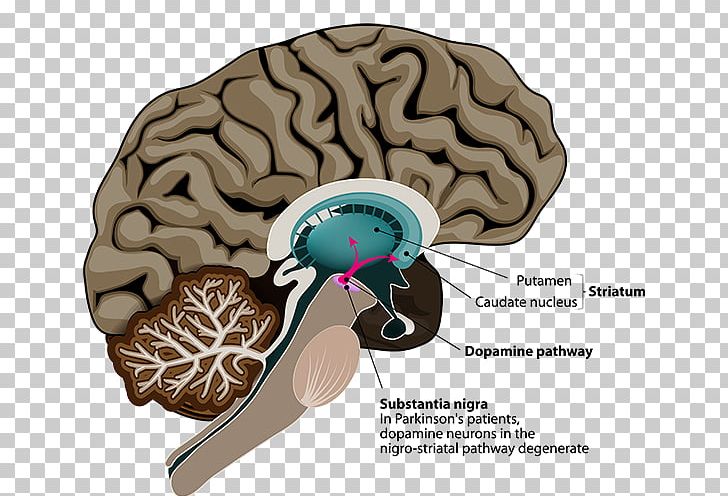 Parkinson's Disease Deep Brain Stimulation Neuroimaging PNG, Clipart,  Free PNG Download
