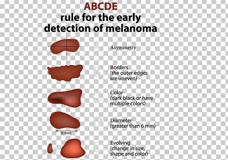 Melanoma Skin Cancer Basal-cell Carcinoma PNG, Clipart, Area, Basalcell Carcinoma, Cancer, Carcinoma, Dermatology Free PNG Download