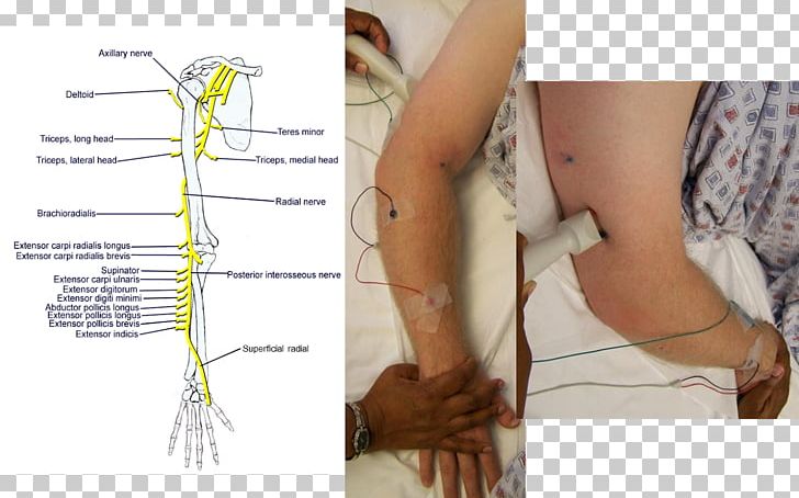 Thumb Radial Nerve Axillary Nerve Muscle PNG, Clipart, Abdomen, Action Potential, Angle, Arm, Axilla Free PNG Download