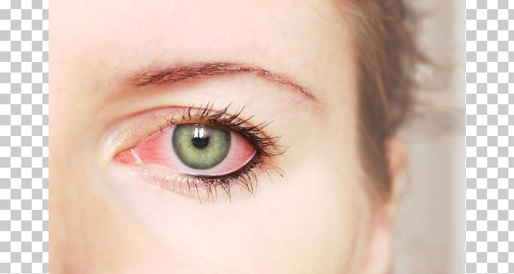 Eyelid Conjunctivitis Rheum Irritation PNG, Clipart, Allergy, Blood Vessel, Cheek, Closeup, Con Free PNG Download