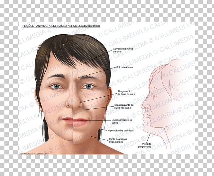 Acromegaly Face Symptom Hypertrophy Growth Hormone PNG, Clipart, Acromegaly, Angle, Cheek, Child, Chin Free PNG Download