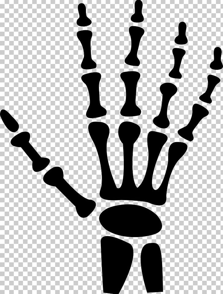 Hand X-ray Radiology Human Body PNG, Clipart, Black And White, Bone, Bones, Carpal Bones, Computer Icons Free PNG Download