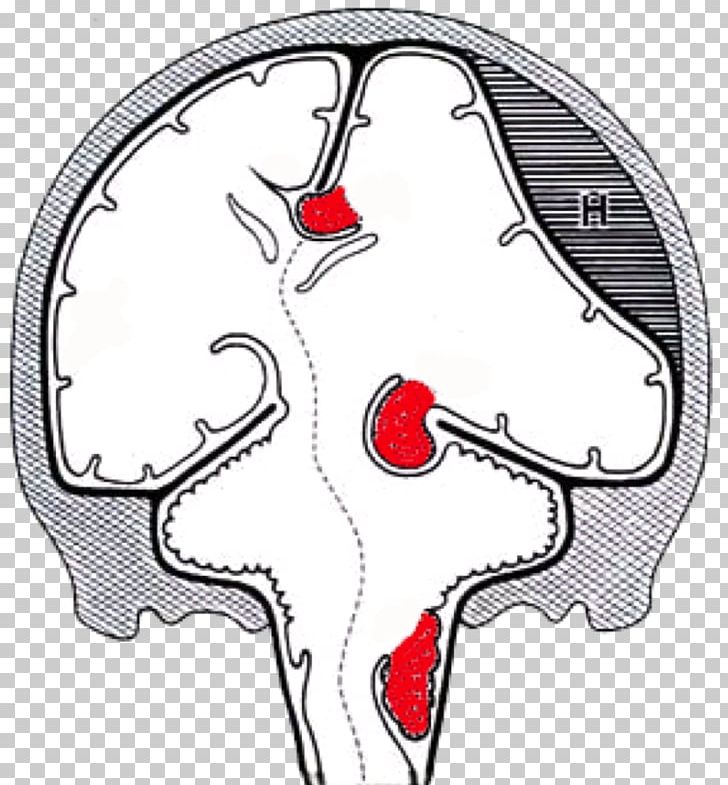 Brain Herniation Intracranial Pressure Uncus PNG, Clipart, Ache, Area, Art, Blue Brain, Brain Free PNG Download