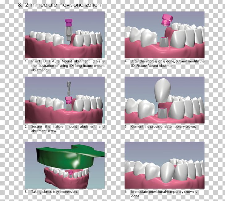 Brand Advertising Plastic PNG, Clipart, Abutment, Advertising, Art, Brand, Plastic Free PNG Download