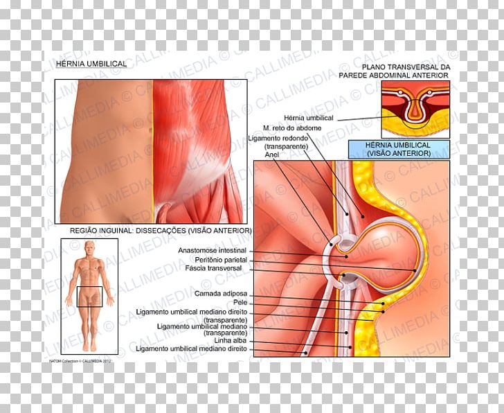 Umbilical Hernia Laparoscopic Inguinal Hernia Repair PNG, Clipart, Abdomen, Abdominal Hernia, Arm, Blood Vessel, Chest Free PNG Download
