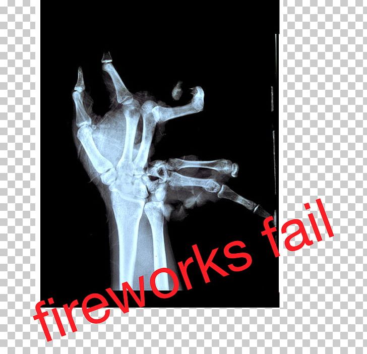 Bone Fracture Hand Humour Forearm PNG, Clipart,  Free PNG Download