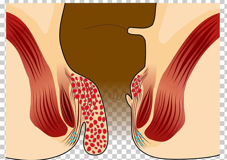 Internal Hemorrhoid Surgery Prolapse Symptom PNG, Clipart, Anal Fistula, Anus, Eyelash, Finger, Fistula Free PNG Download