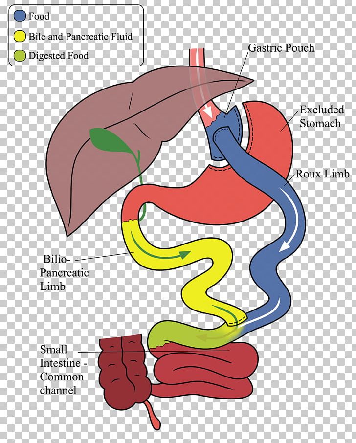 Gastric Bypass Surgery Sleeve Gastrectomy Bariatric Surgery Roux-en-Y Anastomosis PNG, Clipart, Art, Bariatrics, Bariatric Surgery, Bypass Surgery, Cartoon Free PNG Download