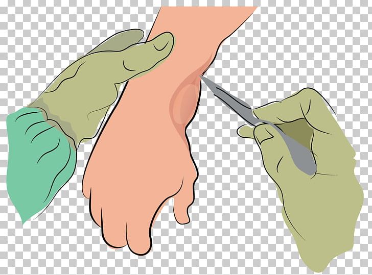 Synovial Cyst Finger Joint Synovial Fluid PNG, Clipart, Arm, Art, Cyst, Cystectomy, Ear Free PNG Download
