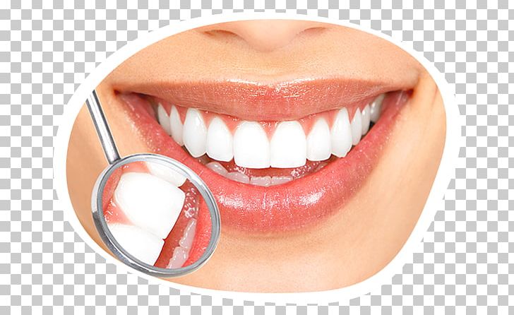 Tooth Whitening Cosmetic Dentistry Human Tooth PNG, Clipart, Bridge, Chin, Cosmetic Dentistry, Crown, Dental Bonding Free PNG Download