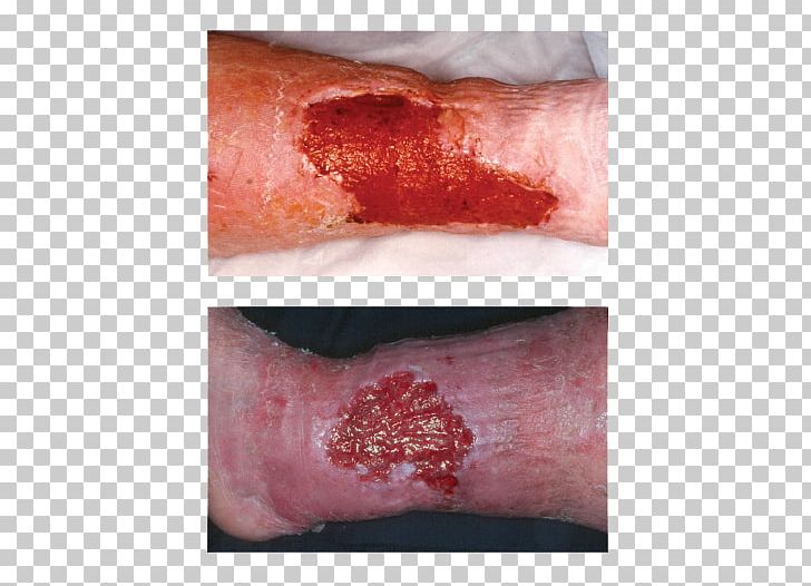Wound Healing Inflammation Dressing PNG, Clipart, Closeup, Disease, Dressing, Finger, Flesh Free PNG Download