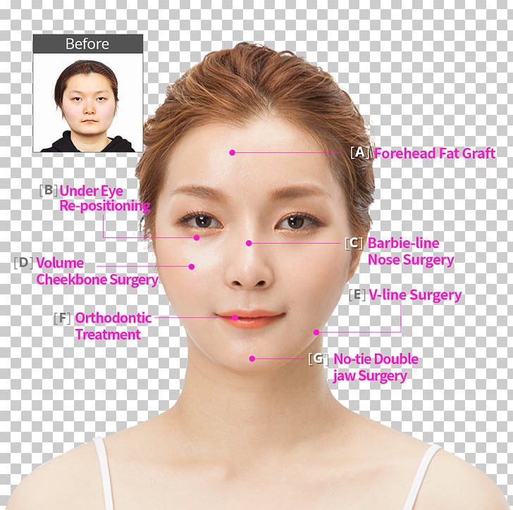 Kim Ji Hyun 美容外科学 South Korea Surgery Hospital PNG, Clipart, Beauty, Cheek, Chin, Dental Chin, Ear Free PNG Download