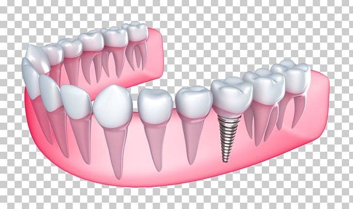 Dental Implant Dentistry Tooth Loss PNG, Clipart, Abutment, Bridge, Cene, Cosmetic Dentistry, Crown Free PNG Download