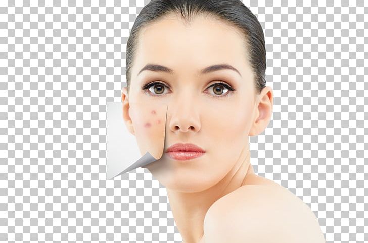Skin Care Health Acne Diet PNG, Clipart, Acne, Beauty, Cheek, Chin, Closeup Free PNG Download