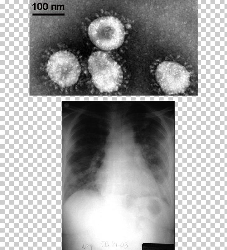 Middle East Respiratory Syndrome Coronavirus Severe Acute Respiratory Syndrome Coronaviridae PNG, Clipart, Computer Wallpaper, Disease, Medical, Monochrome, Monochrome Photography Free PNG Download