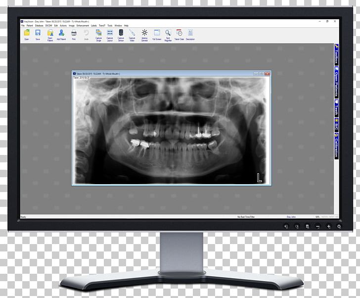 X-ray Vision Dental Radiography Dentistry PNG, Clipart, Apteryx Inc, Brand, Computer Monitor, Computer Monitors, Computer Software Free PNG Download