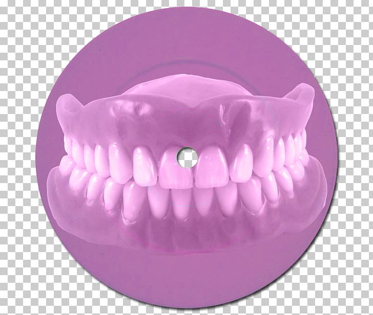 Dentures Dentistry Bridge Dental Implant PNG, Clipart, Bleachers, Bridge, Crown, Dental Composite, Dental Implant Free PNG Download