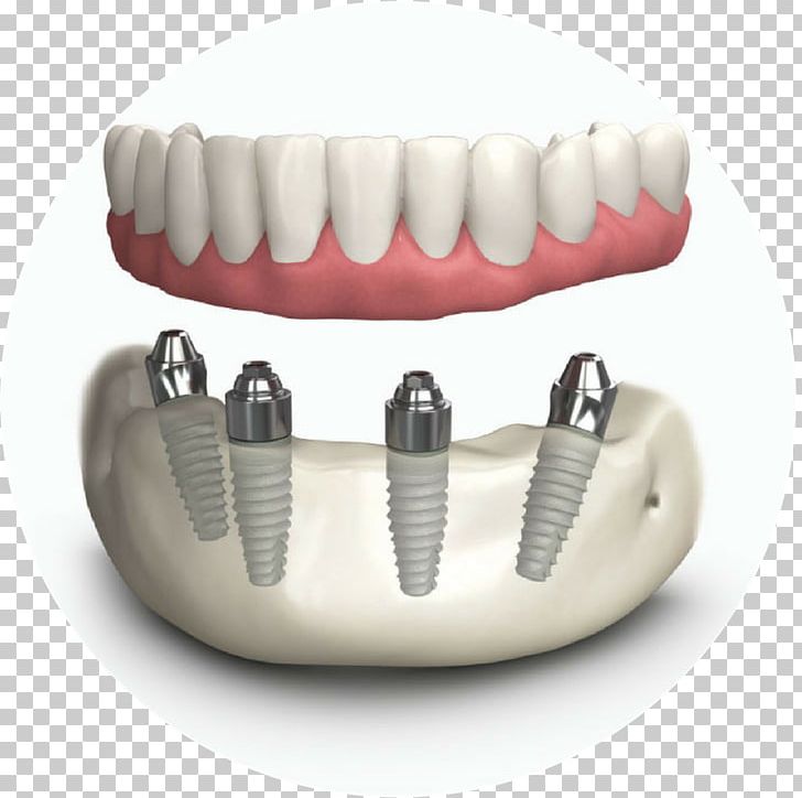 Tooth Dentures Dental Implant Dentistry PNG, Clipart, Allon4, Bone Grafting, Crown Lengthening, Dental, Dental Implant Free PNG Download