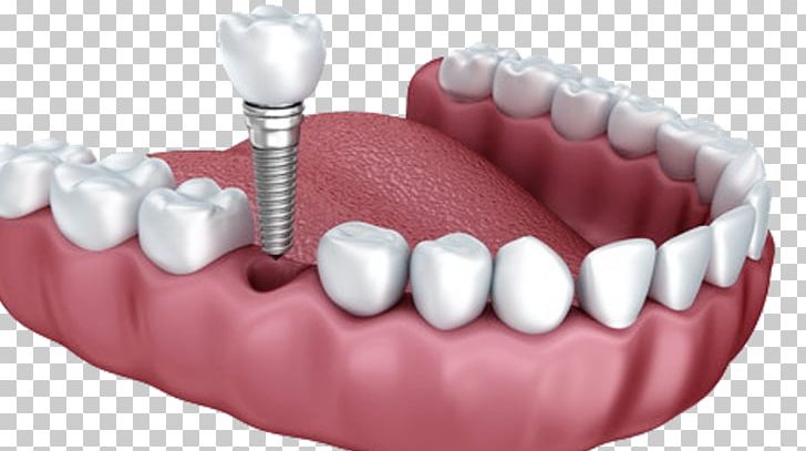 Dental Implant Dentistry Dentures PNG, Clipart, Clinic, Clinica, Cosmetic Dentistry, Dental, Dental Implant Free PNG Download