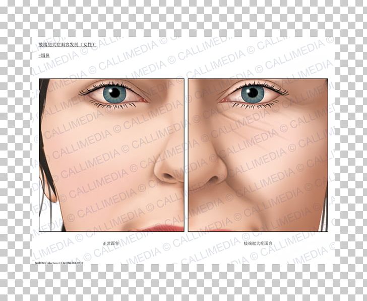 Acromegaly Nose Face Endocrinology Growth Hormone PNG, Clipart, Acromegaly, Blood Sugar, Cheek, Chin, Closeup Free PNG Download