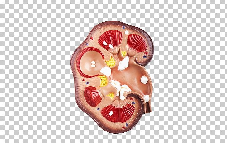 No More Kidney Stones: The Experts Tell You All You Need To Know About Prevention And Treatment Kidney Stones: How To Treat Kidney Stones: How To Prevent Kidney Stones Cure PNG, Clipart, All You Need, Cause, Cure, Disease, Experts Free PNG Download