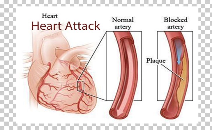 Coronary Artery Disease Coronary Arteries Cardiovascular Disease Heart PNG, Clipart, Abdomen, Angioplasty, Arm, Blood Vessel, Cardiovascular Disease Free PNG Download