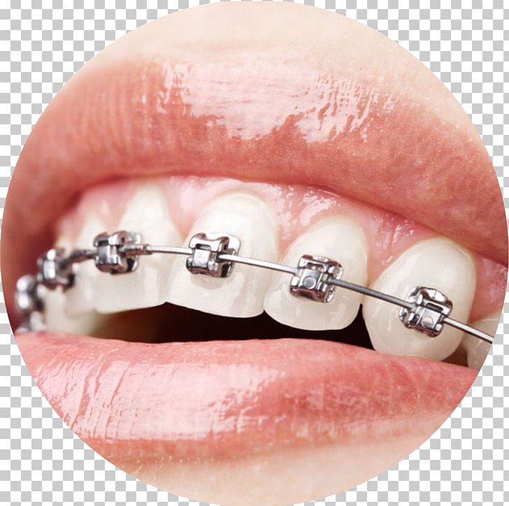 Orthodontics Dental Braces Dentistry Damon System PNG, Clipart, Clear Aligners, Cosmetic Dentistry, Damon System, Dental Care, Dental Implant Free PNG Download