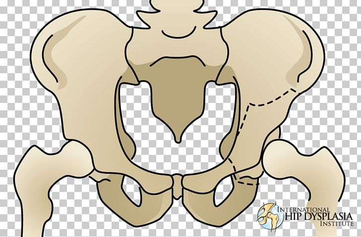 Osteotomy Hip Dysplasia Acetabulum Pelvis PNG, Clipart, Alper, Arm, Bone, Carnivoran, Cartoon Free PNG Download