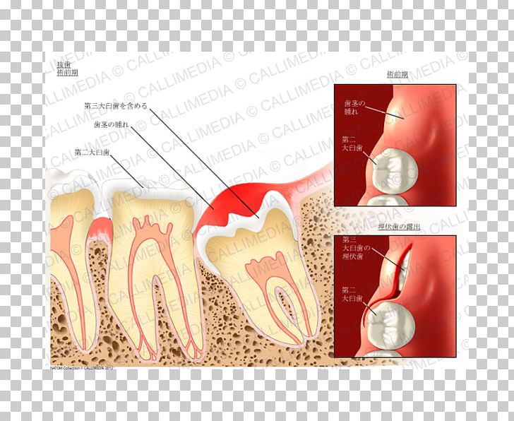 Dental Extraction Tooth Dentistry Molar PNG, Clipart, Canine Tooth, Dental Extraction, Dentist, Dentistry, Extraction Free PNG Download