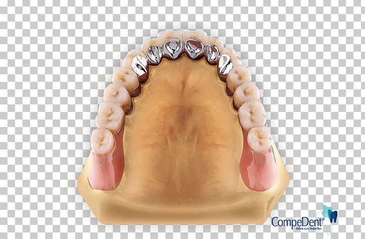 Tooth Dental Laboratory Dentures Removable Partial Denture Dentallabor Klein GmbH PNG, Clipart, Chin, Dental Laboratory, Dental Technician, Dentures, Finger Free PNG Download