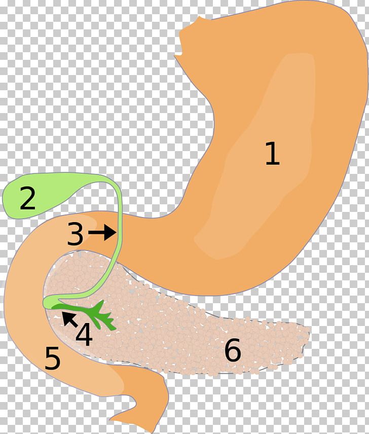 Papillentumor Pancreas Duodenum Gallbladder Pancreatitis PNG, Clipart, Acute Pancreatitis, Adenoma, Area, Arm, Art Free PNG Download