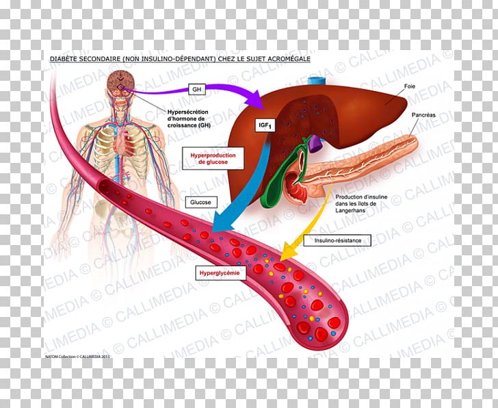 Insulinodependencia Diabetes Mellitus Type 1 Diabetes Type 2 Diabetes PNG, Clipart,  Free PNG Download