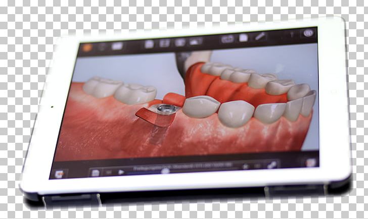 IPad 2 Netbook Dentist Implantology Dental Implant PNG, Clipart, Apple, Dental Implant, Dentist, Dentures, Display Device Free PNG Download
