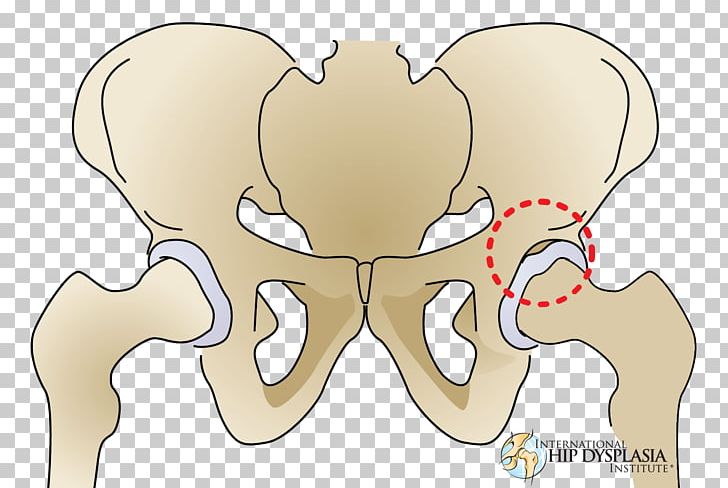 Joint Hip Dysplasia Acetabular Labrum Acetabulum PNG, Clipart, Acetabulum, Arm, Arthroscopy, Bone, Cartoon Free PNG Download
