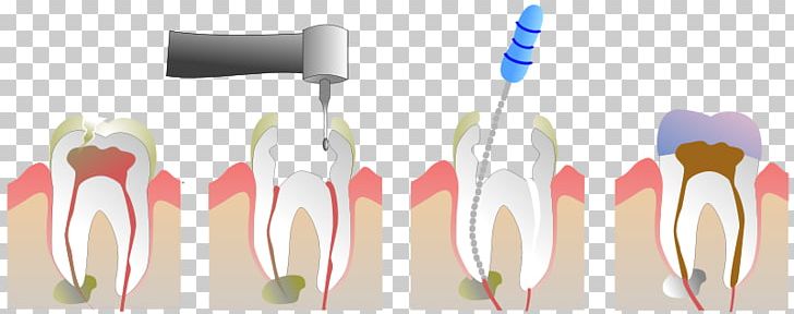 Endodontic Therapy Root Canal Pulp Endodontics Dentistry PNG, Clipart, Brush, Canal, Cutlery, Dental Extraction, Dental Restoration Free PNG Download