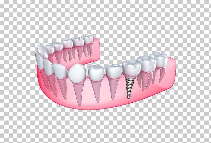 Dental Implant Cosmetic Dentistry Dentures PNG, Clipart, Bridge, Cosmetic Dentistry, Dental Implant, Dental Implants, Dentist Free PNG Download
