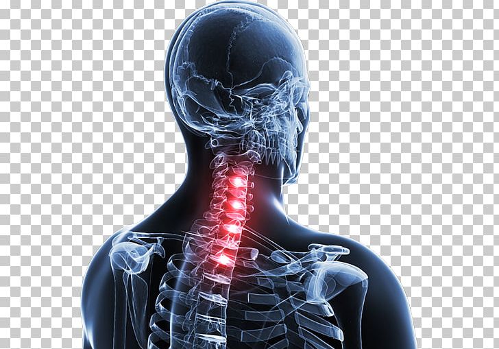 Spinal Disc Herniation Neck Pain Vertebral Column Thoracic Vertebrae PNG, Clipart, Ache, Cervical Vertebrae, Human Skeleton, Jaw, Joint Free PNG Download