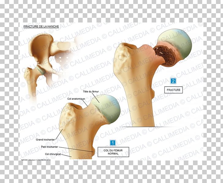 Hip Fracture Shoulder Bone Fracture Femur PNG, Clipart, Anatomy, Arm, Bone, Bone Fracture, Ear Free PNG Download