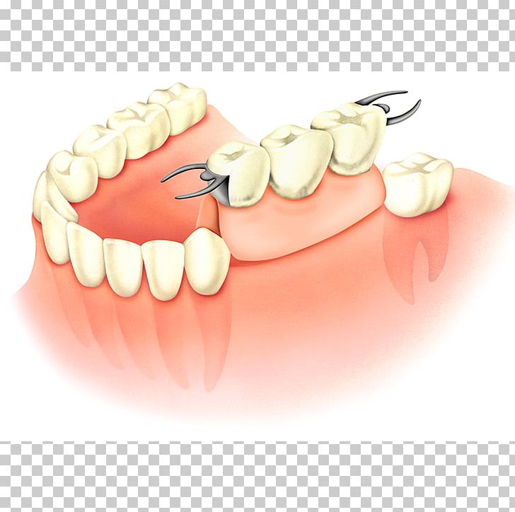 Tooth Dentures Dental Implant Prosthesis Dentistry PNG, Clipart,  Free PNG Download