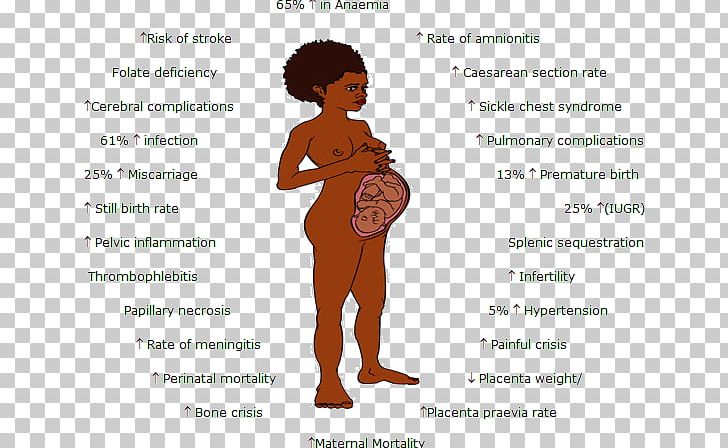 Sickle Cell Disease Pregnancy Anemia PNG, Clipart, Are, Arm, Childbirth, Complication, Complications Of Pregnancy Free PNG Download