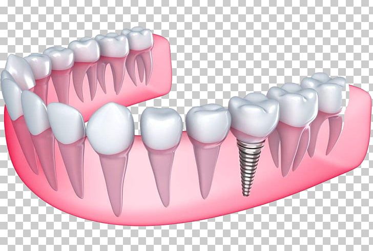 Desert View Dental Dental Implant Dentistry Dentures PNG, Clipart, Abutment, Brush, Cosmetic Dentistry, Dental, Dental Implant Free PNG Download