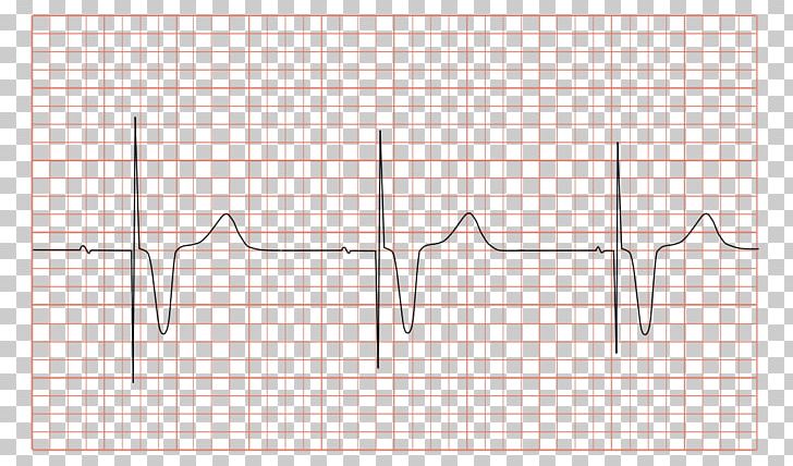 Artificial Cardiac Pacemaker Electrocardiography Pacemaker Syndrome Multifocal Atrial Tachycardia Medicine PNG, Clipart, Angle, Area, Artificial Cardiac Pacemaker, Atrial Fibrillation, Atrium Free PNG Download