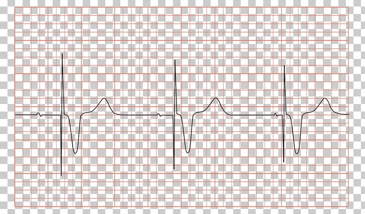 Artificial Cardiac Pacemaker Electrocardiography Pacemaker Syndrome ...