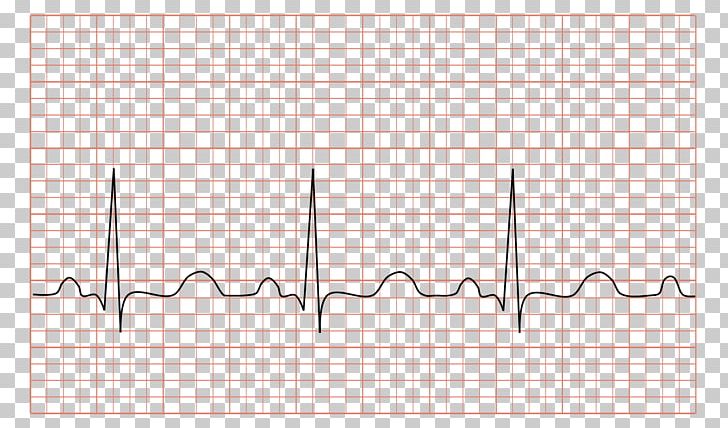 Electrocardiography Tachycardia Heart Rate Cardiology PNG, Clipart, Angle, Area, Cardiology, Cardiovascular Disease, Child Free PNG Download