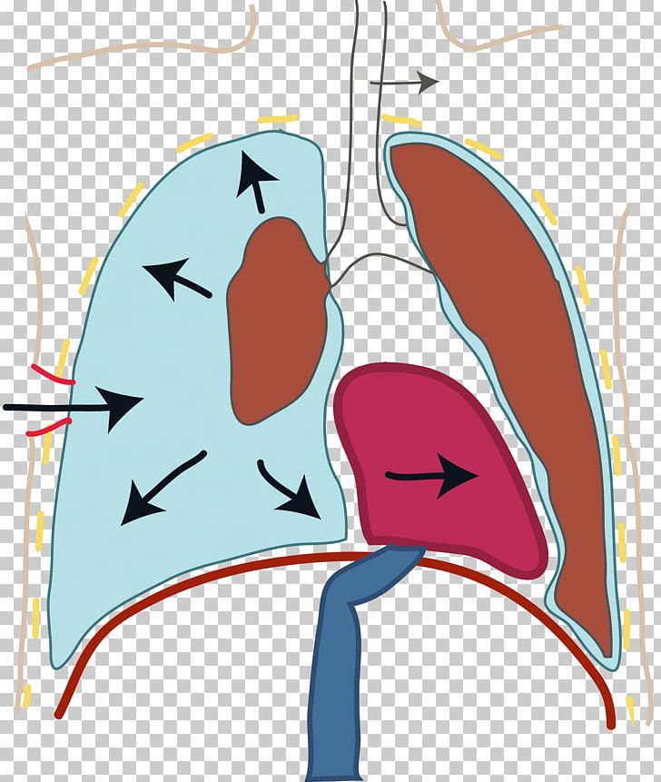 Cyanosis Heart Ailment Cardiology Orthopnea PNG, Clipart, Art, Arterial Blood Gas Test, Artwork, Cardiology, Cartoon Free PNG Download